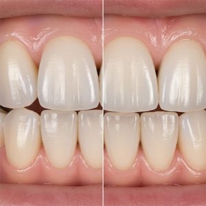 КОРОНКИ ИЛИ ВИНИРЫ