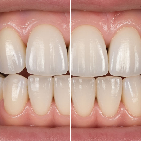 КОРОНКИ ИЛИ ВИНИРЫ